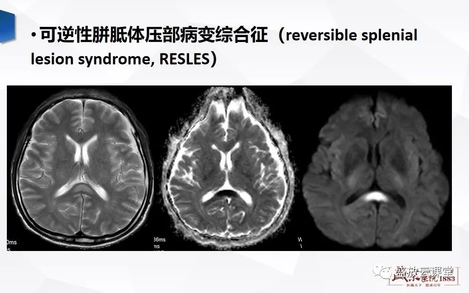 影像PPT - 【PPT】DWI成像原理及应用-13