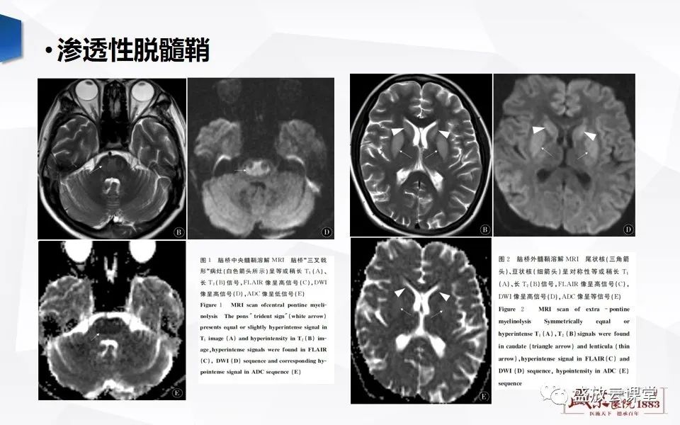 影像PPT - 【PPT】DWI成像原理及应用-17