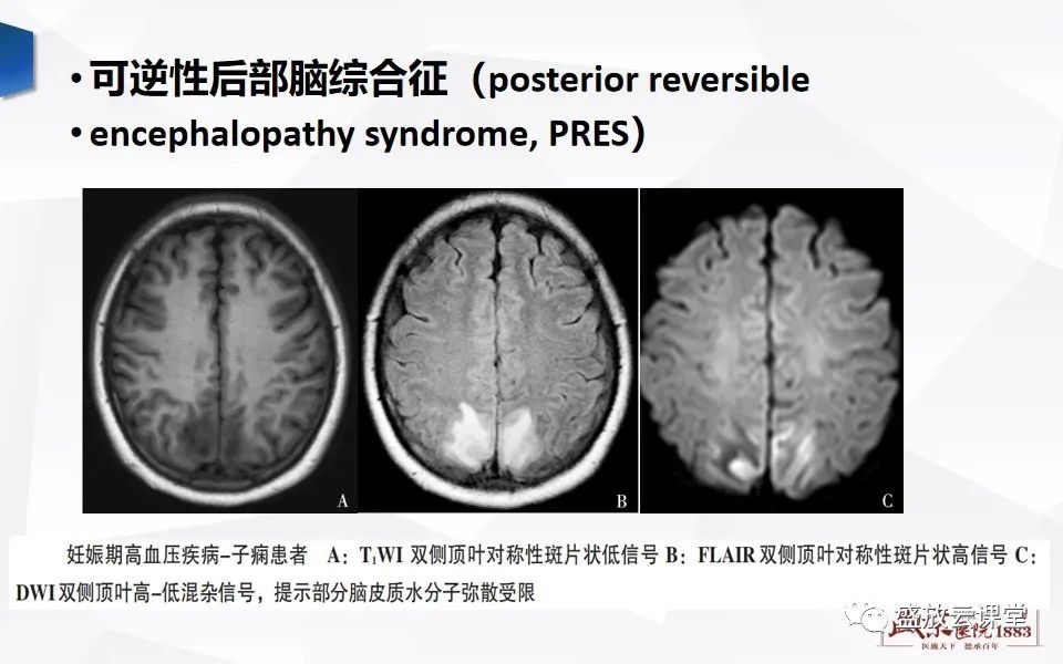 影像PPT - 【PPT】DWI成像原理及应用-15