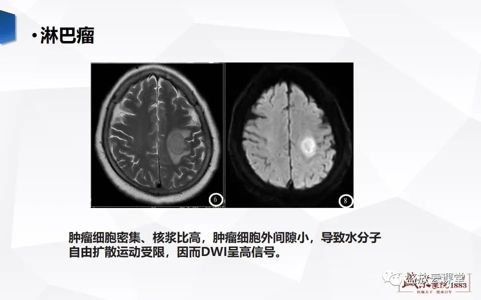 影像PPT - 【PPT】DWI成像原理及应用-20