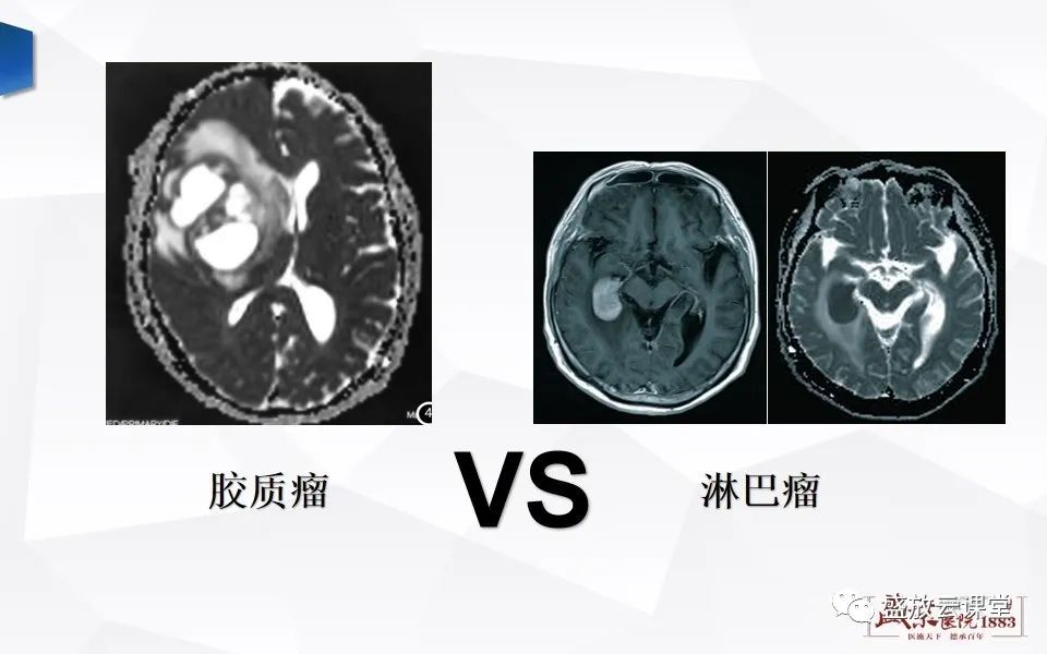 影像PPT - 【PPT】DWI成像原理及应用-21