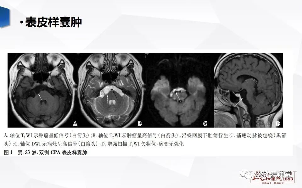 影像PPT - 【PPT】DWI成像原理及应用-24