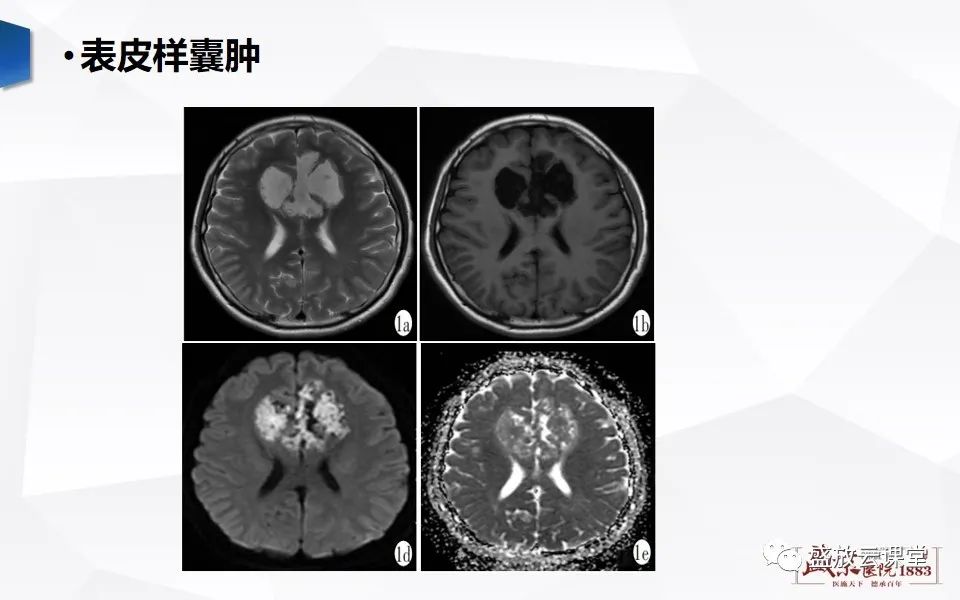 影像PPT - 【PPT】DWI成像原理及应用-25