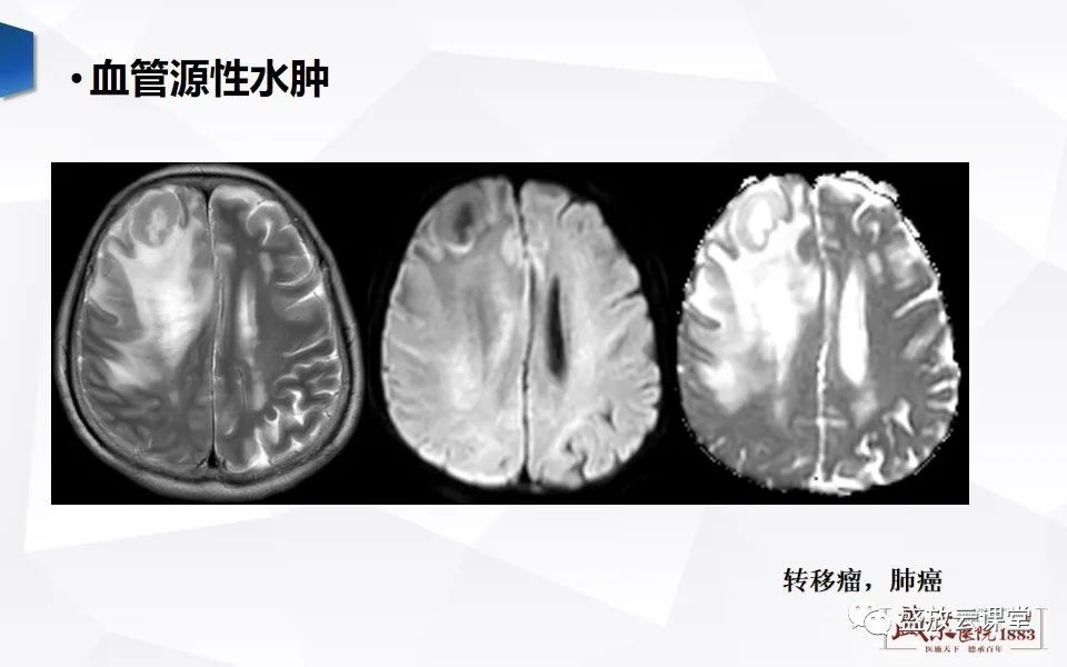 影像PPT - 【PPT】DWI成像原理及应用-27