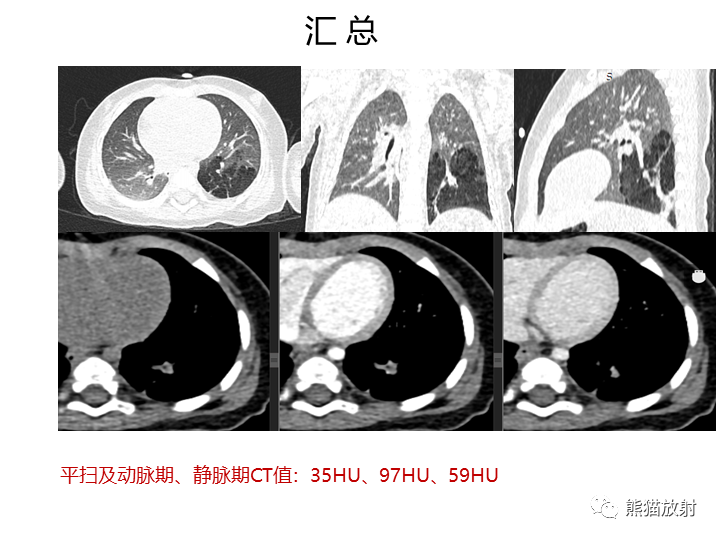 影像PPT - 【病例】先天性肺气道畸形 VS 先天性肺叶过度充气（肺气肿）-7