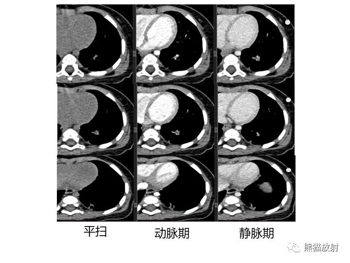 影像PPT - 【病例】先天性肺气道畸形 VS 先天性肺叶过度充气（肺气肿）-6