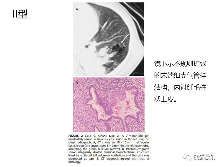 影像PPT - 【病例】先天性肺气道畸形 VS 先天性肺叶过度充气（肺气肿）-27