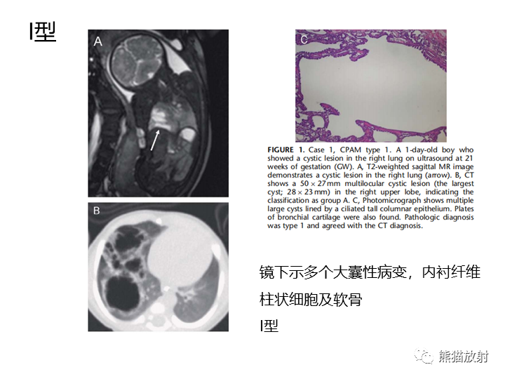 影像PPT - 【病例】先天性肺气道畸形 VS 先天性肺叶过度充气（肺气肿）-26