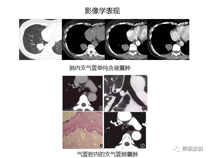 影像PPT - 【病例】先天性肺气道畸形 VS 先天性肺叶过度充气（肺气肿）-39