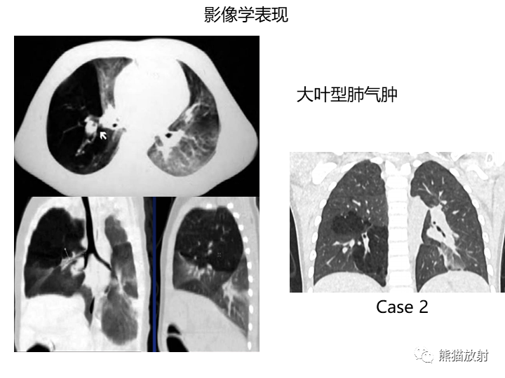 影像PPT - 【病例】先天性肺气道畸形 VS 先天性肺叶过度充气（肺气肿）-37