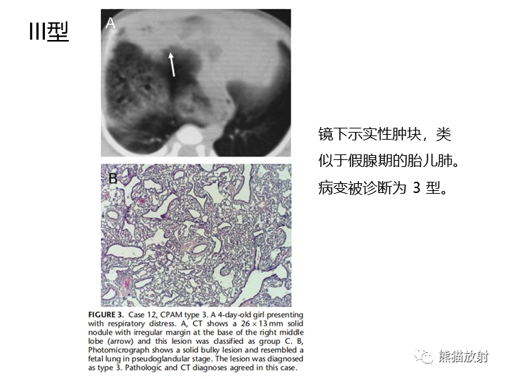 影像PPT - 【病例】先天性肺气道畸形 VS 先天性肺叶过度充气（肺气肿）-28