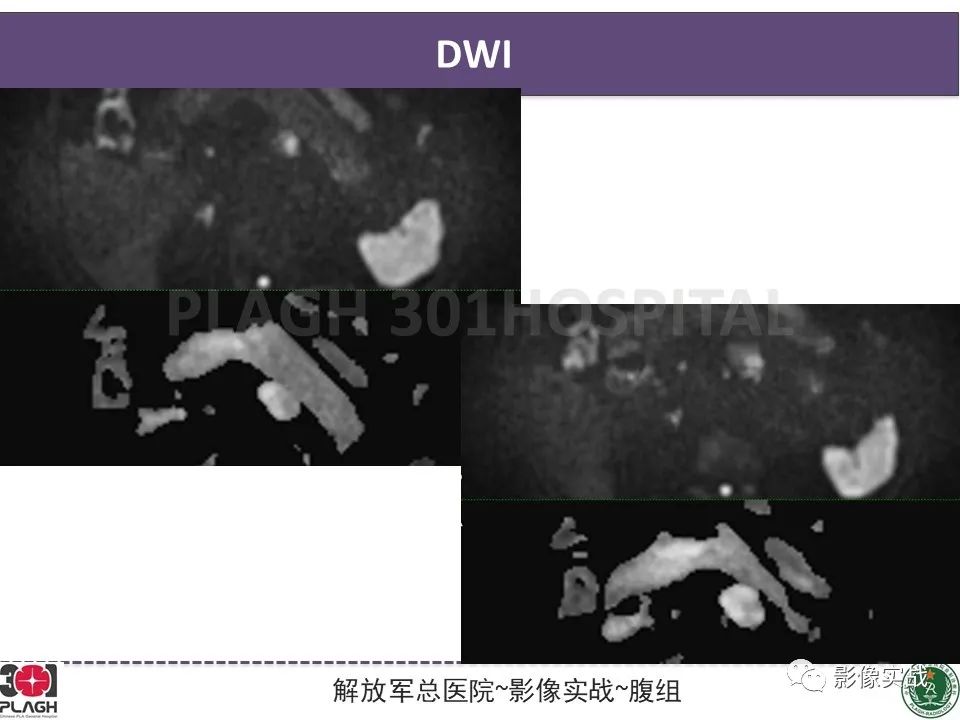 影像PPT - 【PPT】胰腺导管乳头管粘液瘤IPMN一例MR-6
