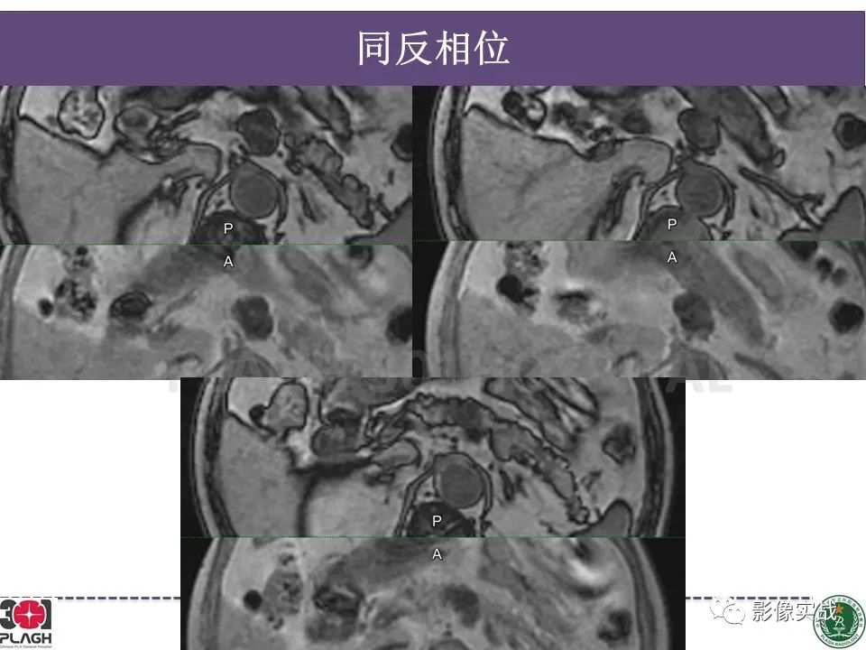 影像PPT - 【PPT】胰腺导管乳头管粘液瘤IPMN一例MR-5