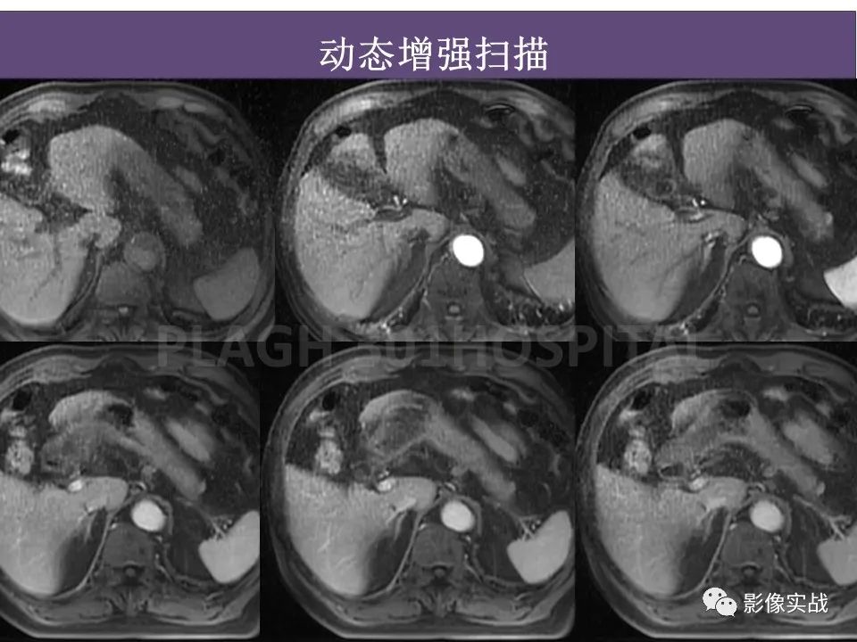 影像PPT - 【PPT】胰腺导管乳头管粘液瘤IPMN一例MR-7