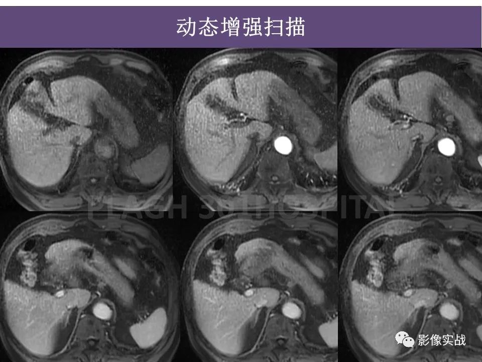 影像PPT - 【PPT】胰腺导管乳头管粘液瘤IPMN一例MR-8