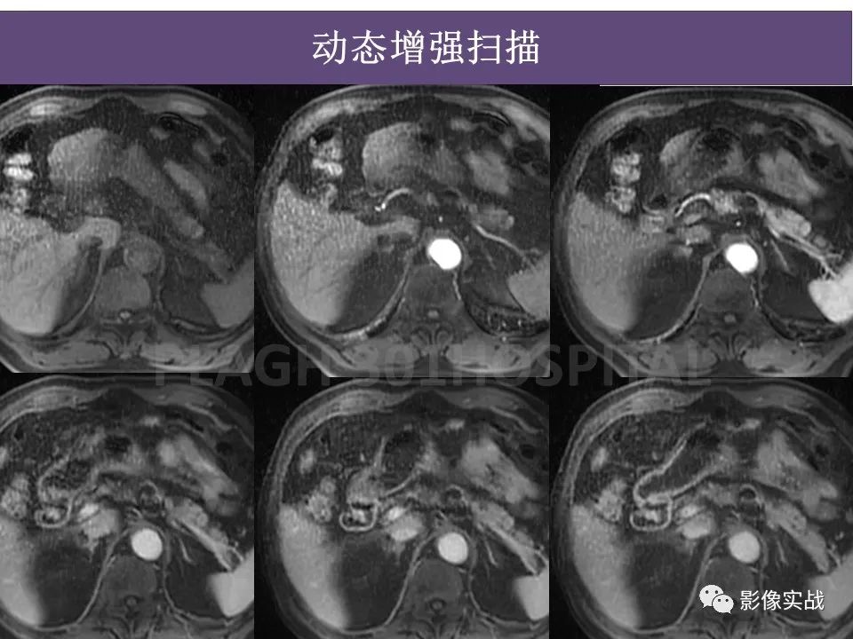 影像PPT - 【PPT】胰腺导管乳头管粘液瘤IPMN一例MR-9