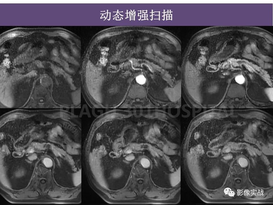 影像PPT - 【PPT】胰腺导管乳头管粘液瘤IPMN一例MR-10