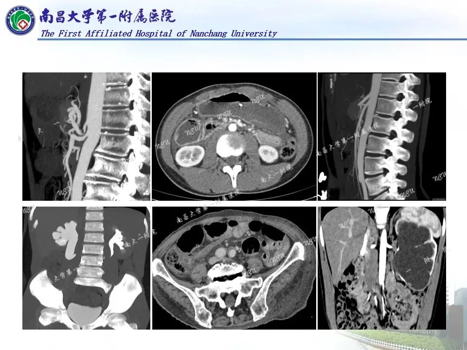 影像PPT - 【PPT】浅谈血管压迫综合征-2