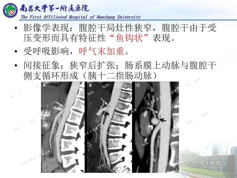 影像PPT - 【PPT】浅谈血管压迫综合征-6