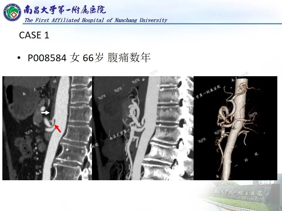 影像PPT - 【PPT】浅谈血管压迫综合征-7