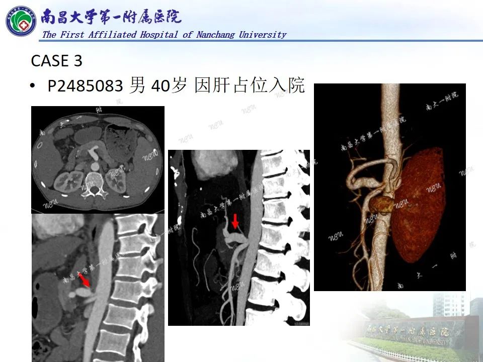 影像PPT - 【PPT】浅谈血管压迫综合征-10