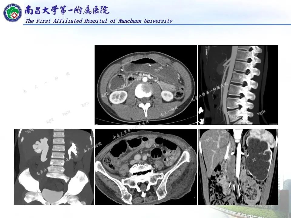 影像PPT - 【PPT】浅谈血管压迫综合征-13