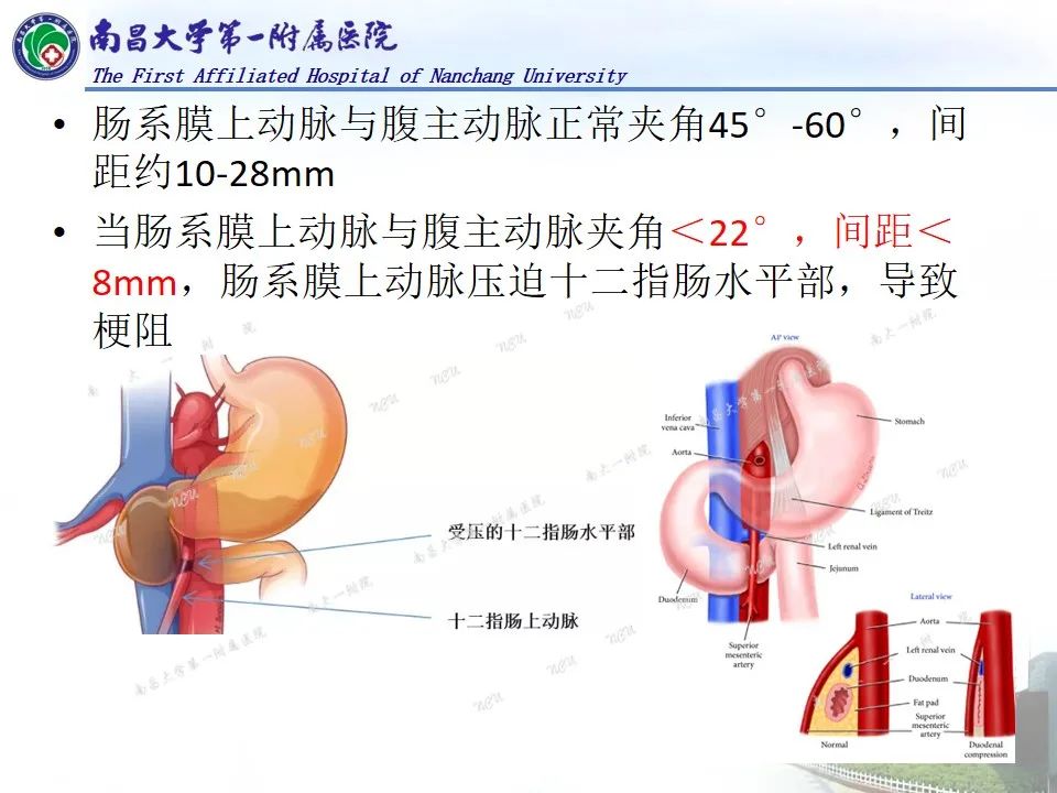 影像PPT - 【PPT】浅谈血管压迫综合征-15
