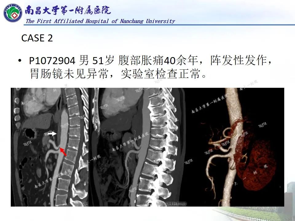 影像PPT - 【PPT】浅谈血管压迫综合征-8