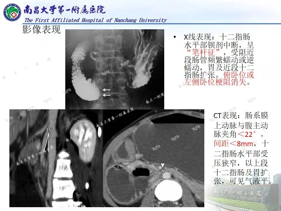 影像PPT - 【PPT】浅谈血管压迫综合征-17