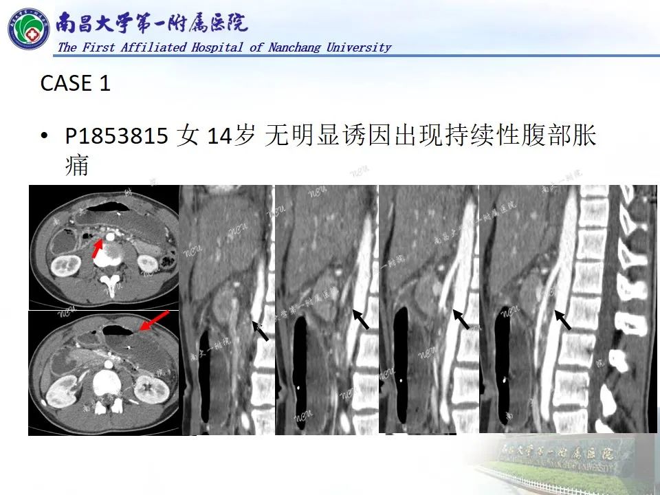 影像PPT - 【PPT】浅谈血管压迫综合征-18