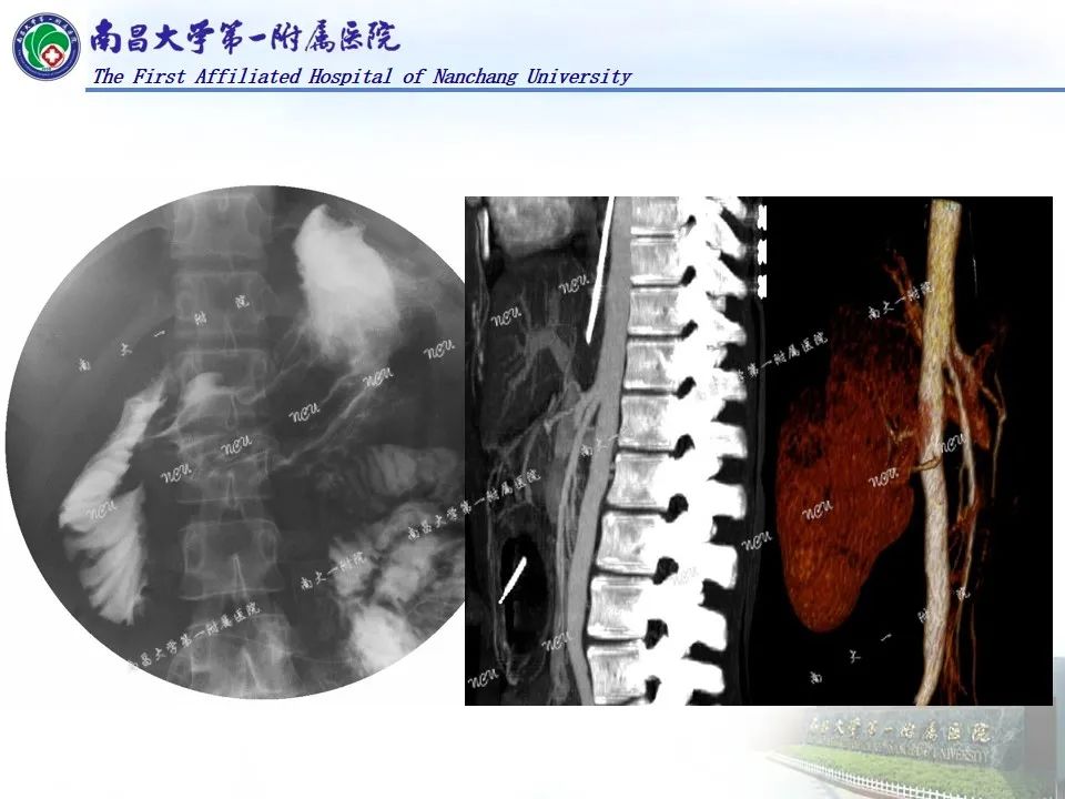 影像PPT - 【PPT】浅谈血管压迫综合征-19