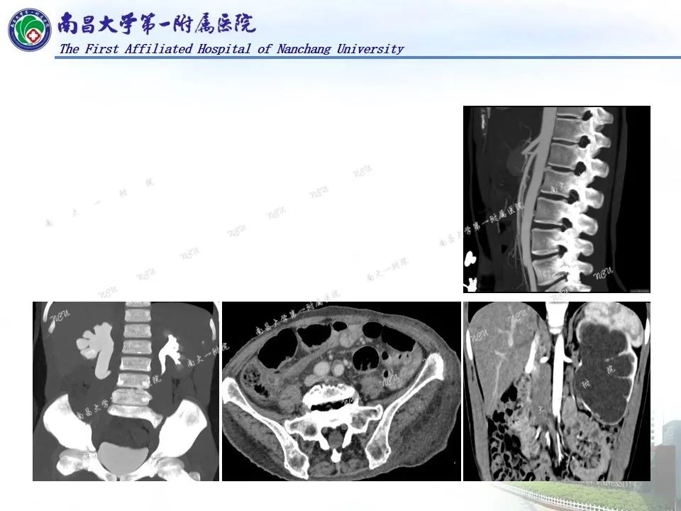 影像PPT - 【PPT】浅谈血管压迫综合征-21