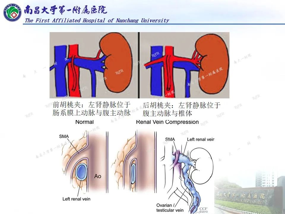 影像PPT - 【PPT】浅谈血管压迫综合征-23
