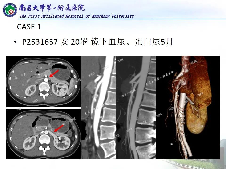 影像PPT - 【PPT】浅谈血管压迫综合征-25