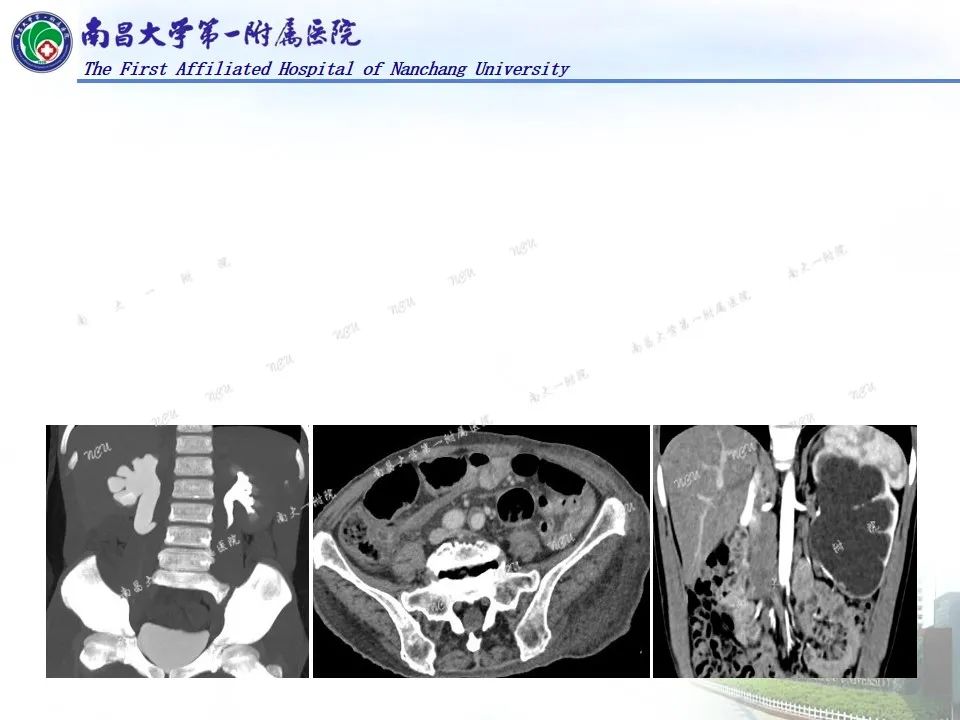 影像PPT - 【PPT】浅谈血管压迫综合征-27