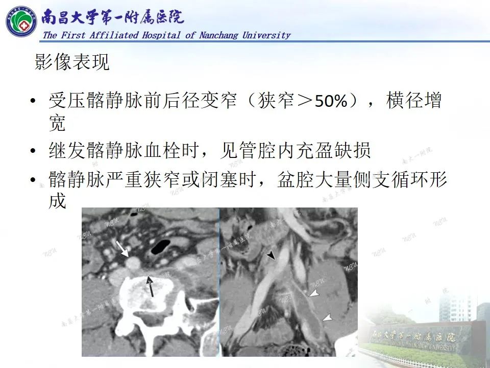 影像PPT - 【PPT】浅谈血管压迫综合征-31