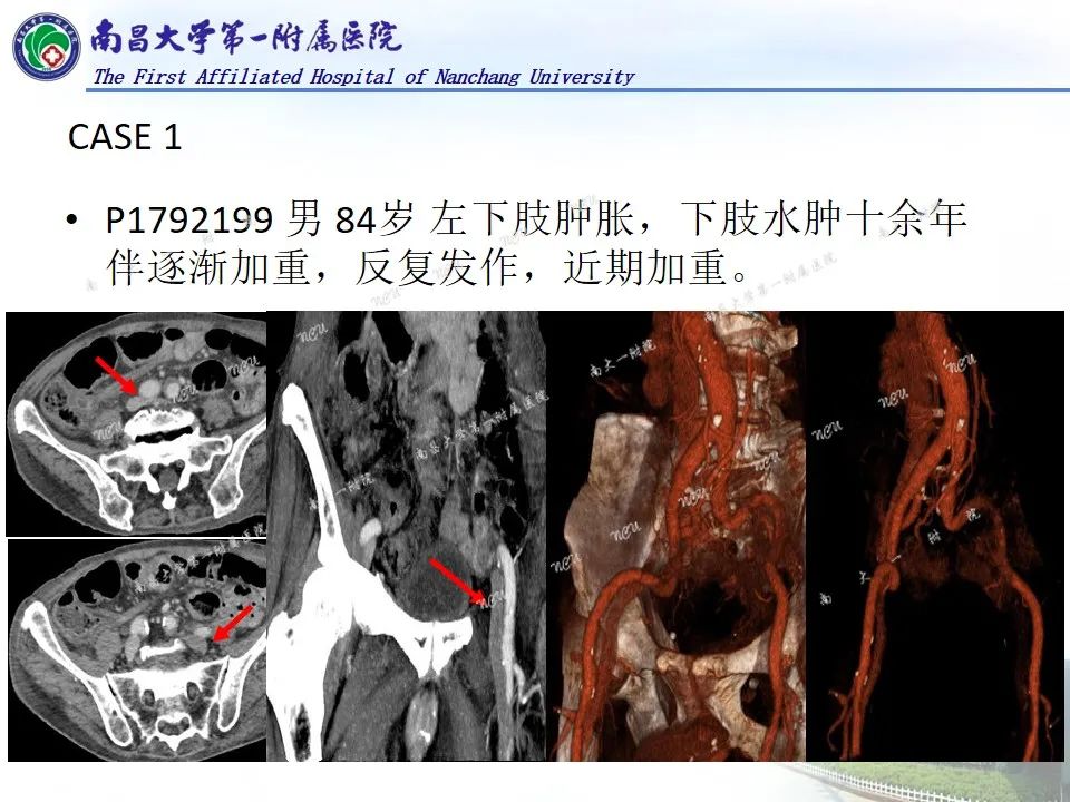 影像PPT - 【PPT】浅谈血管压迫综合征-32