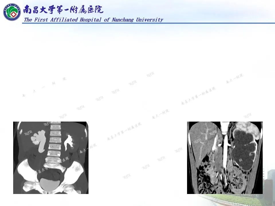 影像PPT - 【PPT】浅谈血管压迫综合征-34