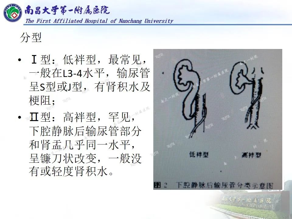 影像PPT - 【PPT】浅谈血管压迫综合征-37