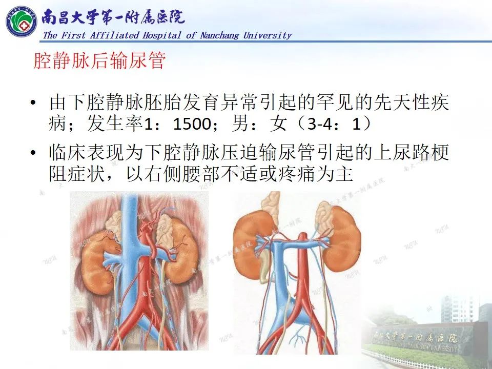 影像PPT - 【PPT】浅谈血管压迫综合征-35