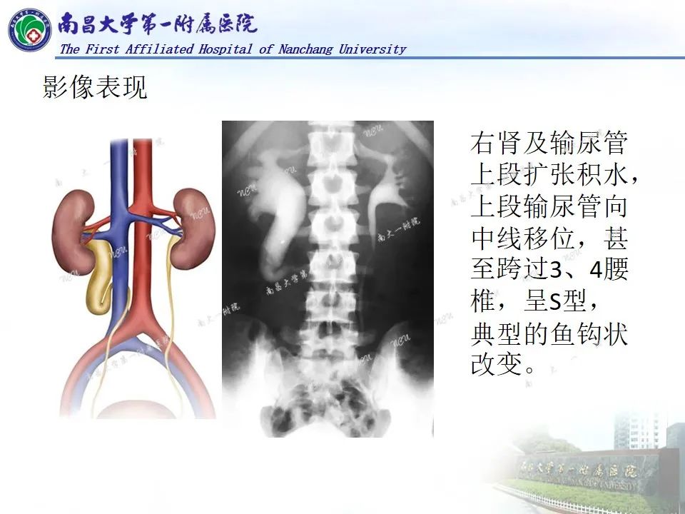 影像PPT - 【PPT】浅谈血管压迫综合征-38