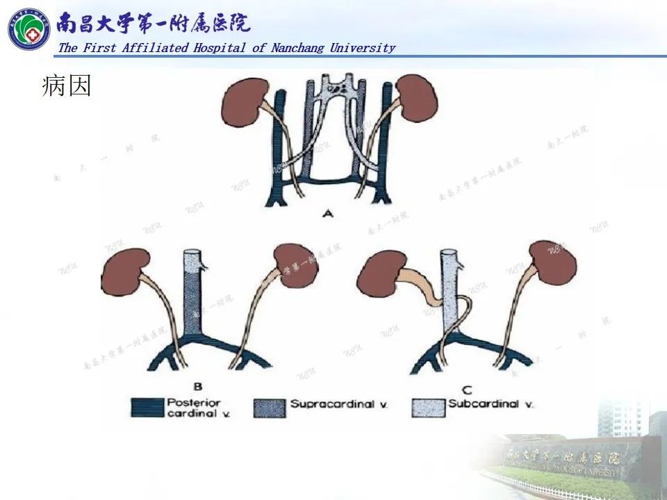 影像PPT - 【PPT】浅谈血管压迫综合征-36