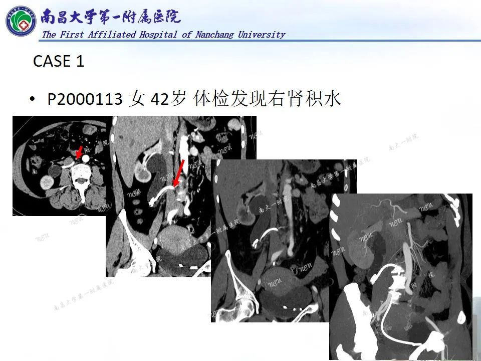 影像PPT - 【PPT】浅谈血管压迫综合征-39