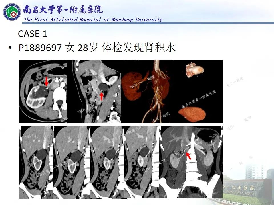 影像PPT - 【PPT】浅谈血管压迫综合征-45