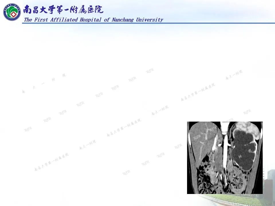 影像PPT - 【PPT】浅谈血管压迫综合征-42