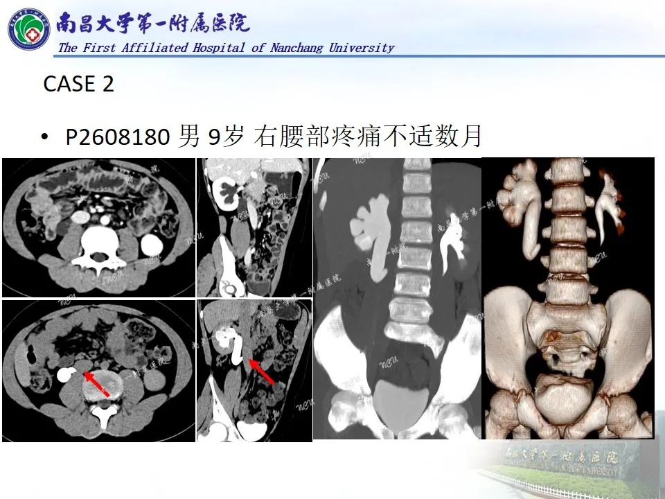 影像PPT - 【PPT】浅谈血管压迫综合征-40