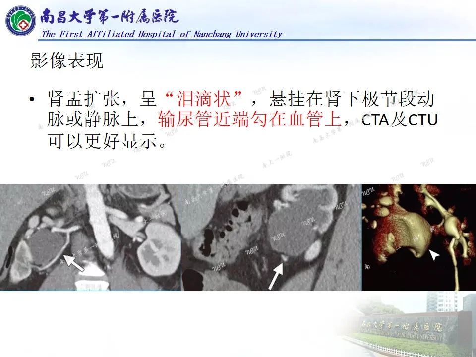 影像PPT - 【PPT】浅谈血管压迫综合征-44