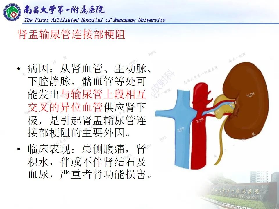 影像PPT - 【PPT】浅谈血管压迫综合征-43