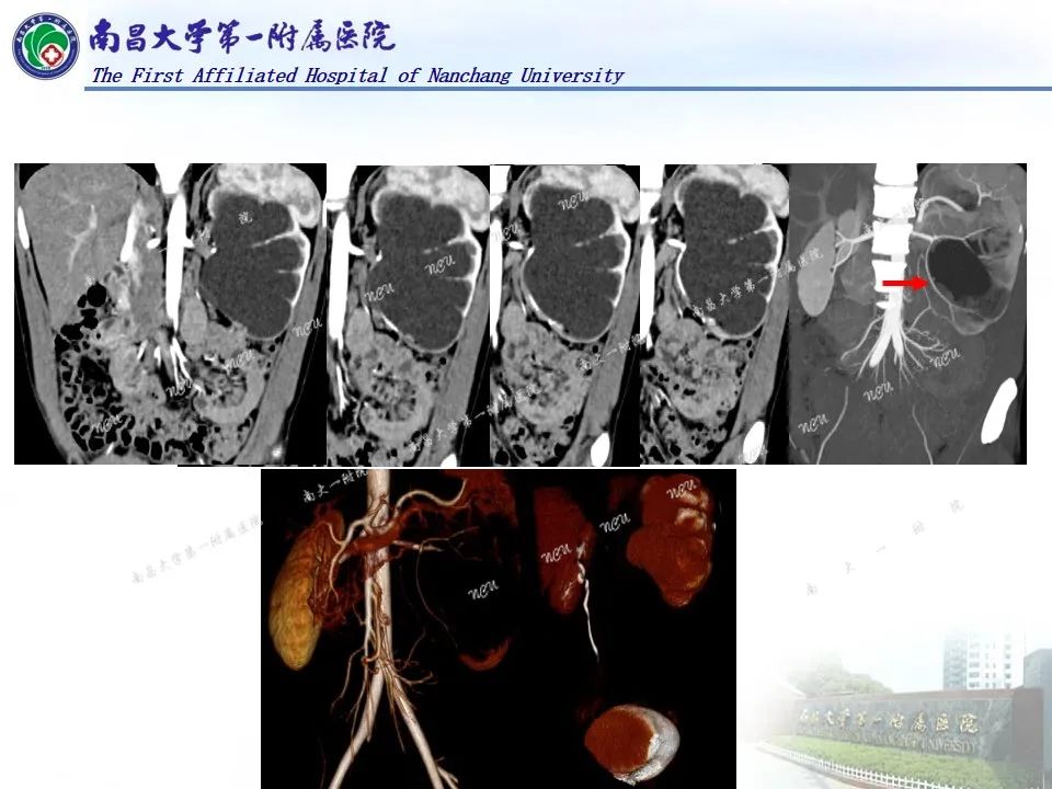 影像PPT - 【PPT】浅谈血管压迫综合征-47