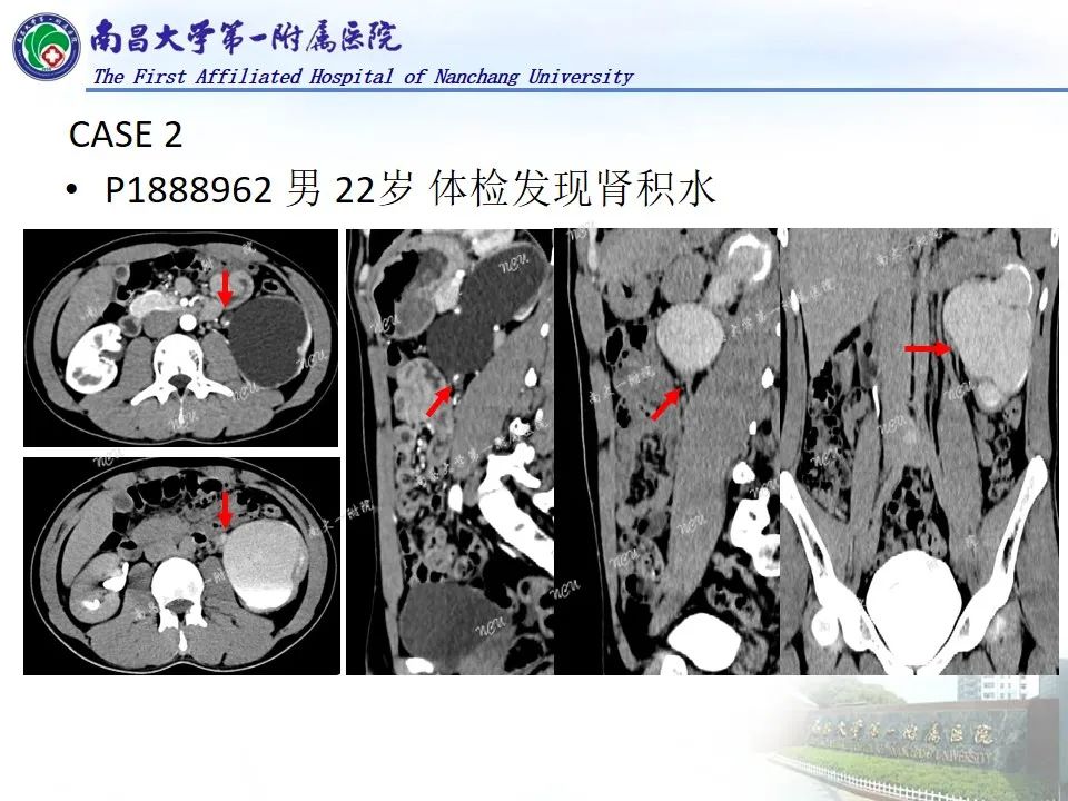 影像PPT - 【PPT】浅谈血管压迫综合征-46